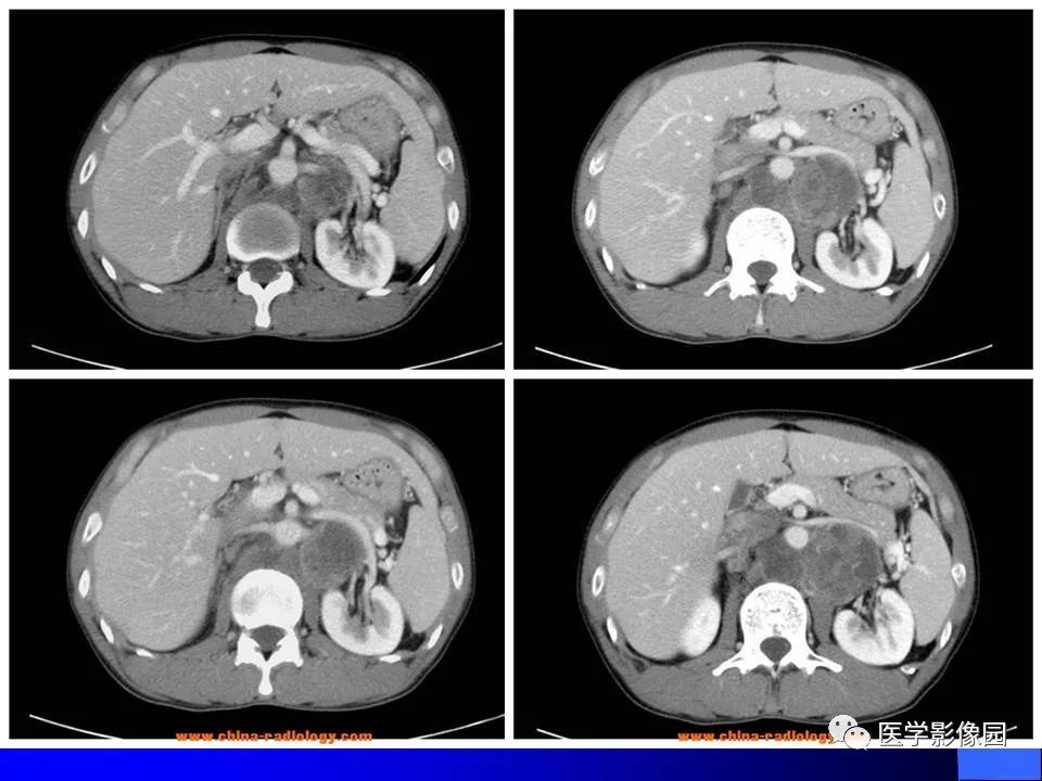 【病例】睾丸精原细胞瘤伴腹膜后转移1例CT