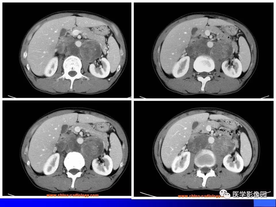 【病例】睾丸精原细胞瘤伴腹膜后转移1例CT