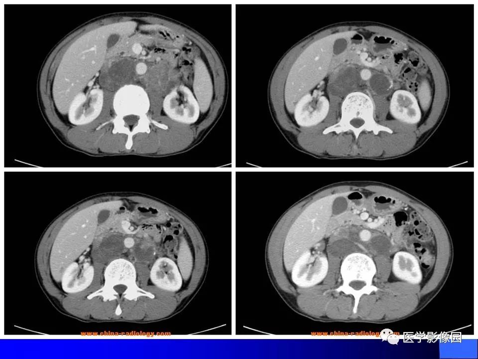 【病例】睾丸精原细胞瘤伴腹膜后转移1例CT