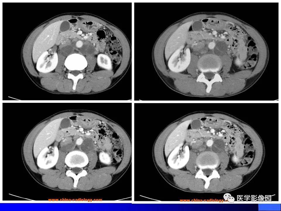 【病例】睾丸精原细胞瘤伴腹膜后转移1例CT