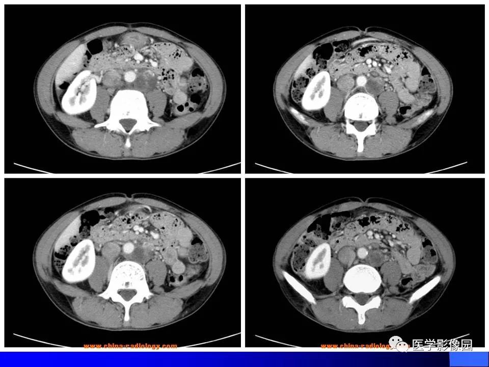 【病例】睾丸精原细胞瘤伴腹膜后转移1例CT