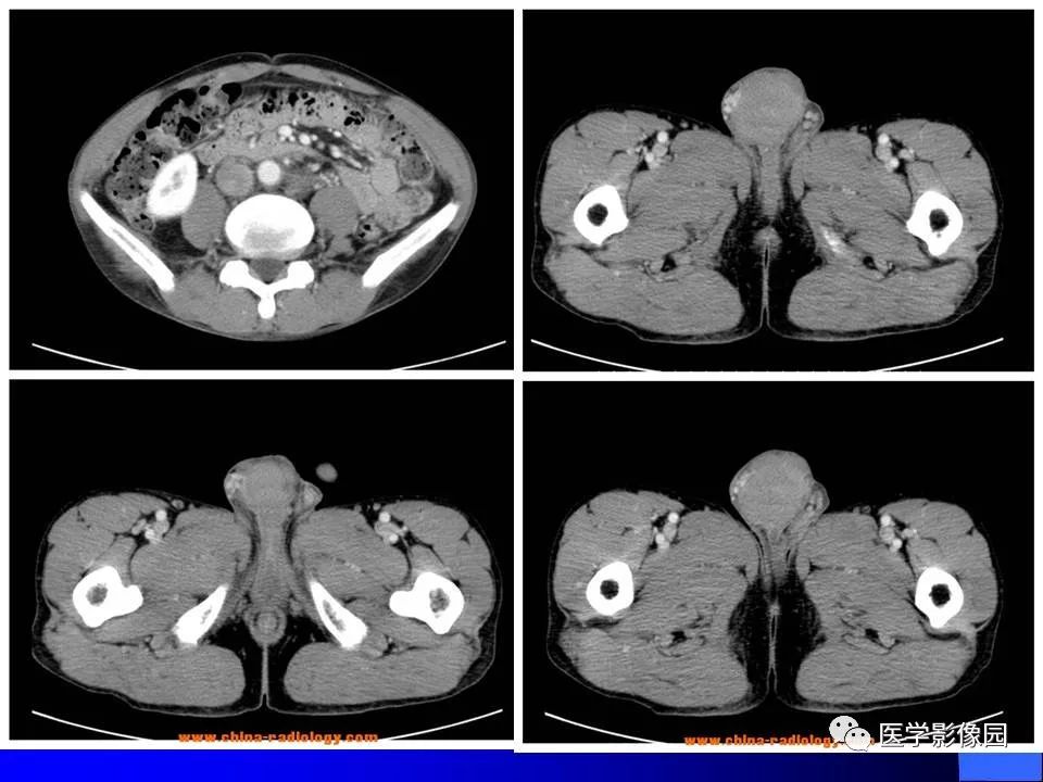 【病例】睾丸精原细胞瘤伴腹膜后转移1例CT