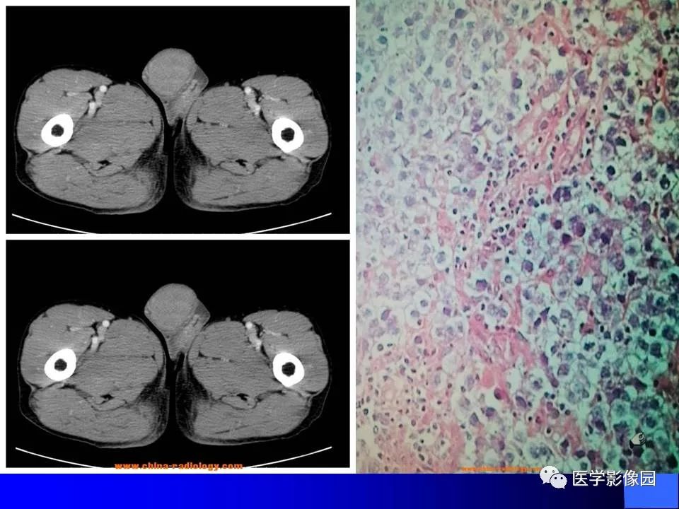 【病例】睾丸精原细胞瘤伴腹膜后转移1例CT