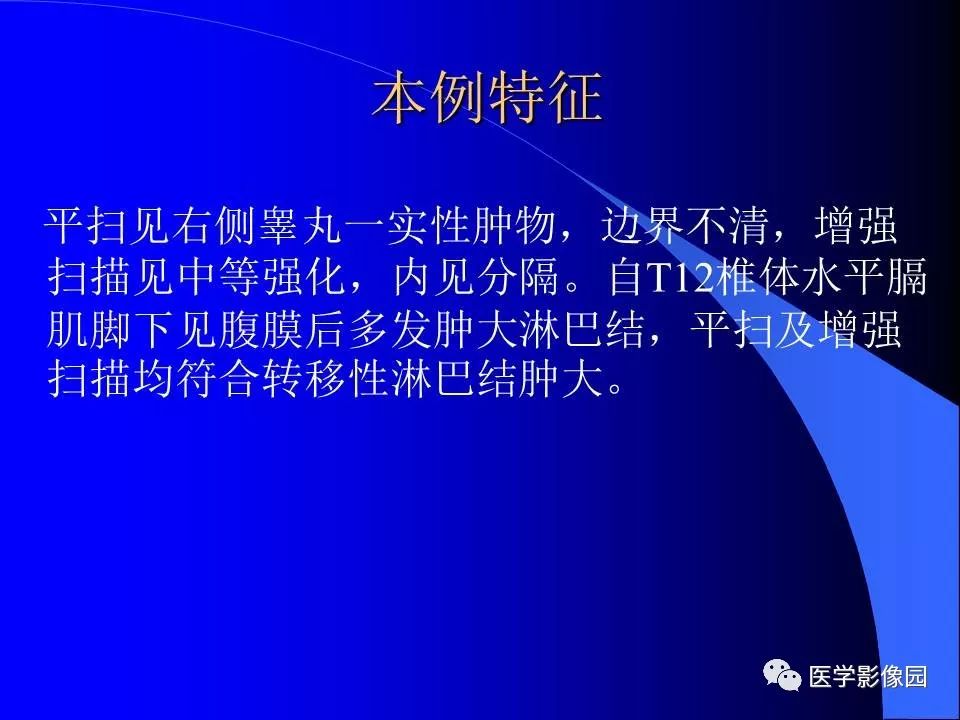 【病例】睾丸精原细胞瘤伴腹膜后转移1例CT