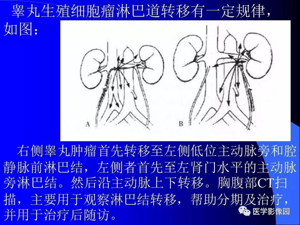 【病例】睾丸精原细胞瘤伴腹膜后转移1例CT