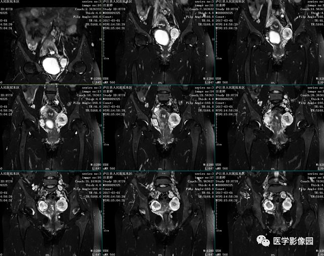 【病例】神经纤维瘤病I型1例MR 【病例】神经纤维瘤病I型1例MR