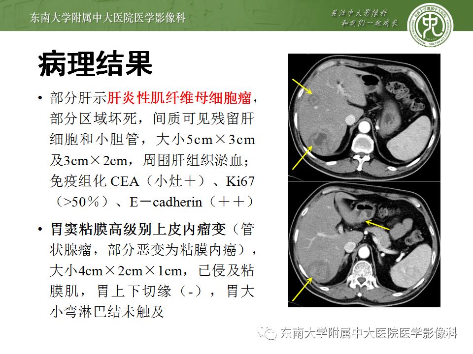【病例】肝脏炎性肌纤维母细胞瘤1例CT影像表现