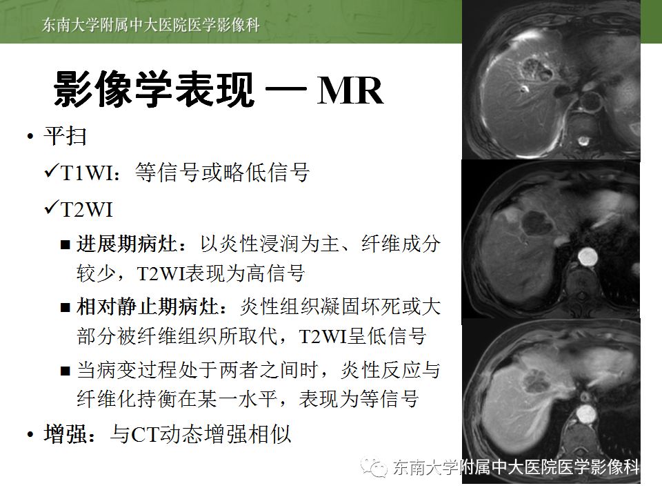 【病例】肝脏炎性肌纤维母细胞瘤1例CT影像表现