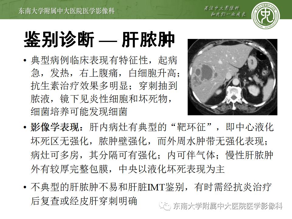 【病例】肝脏炎性肌纤维母细胞瘤1例CT影像表现