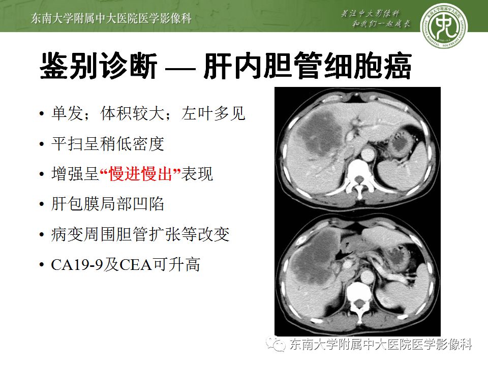 【病例】肝脏炎性肌纤维母细胞瘤1例CT影像表现