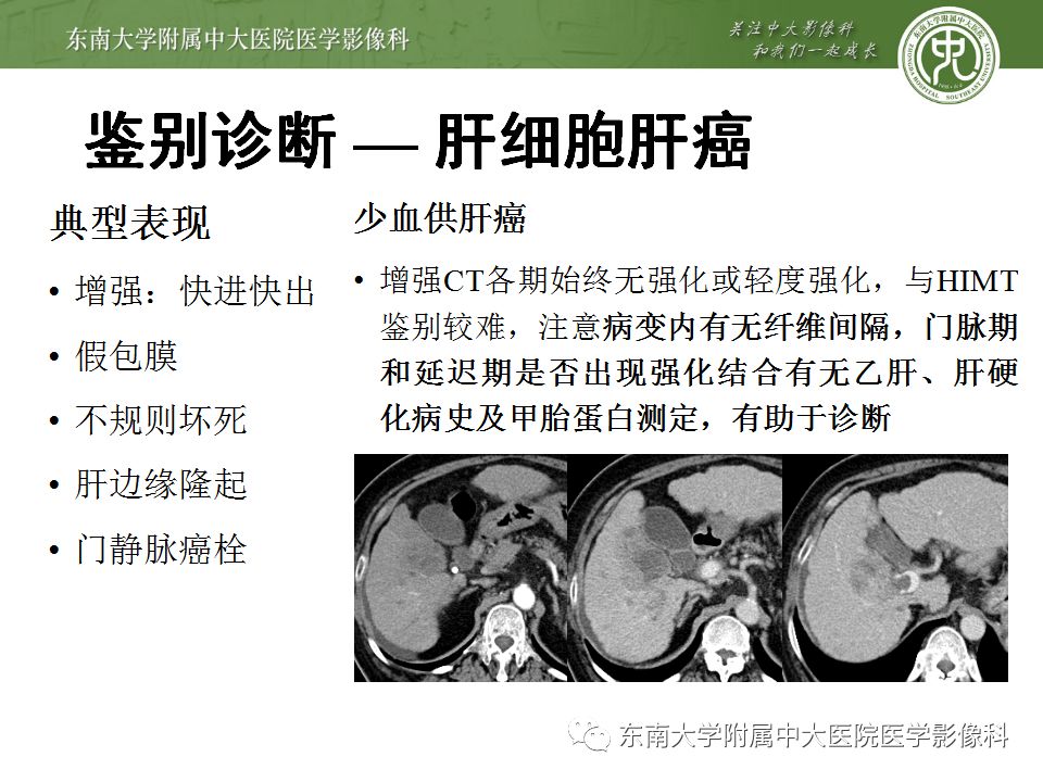【病例】肝脏炎性肌纤维母细胞瘤1例CT影像表现