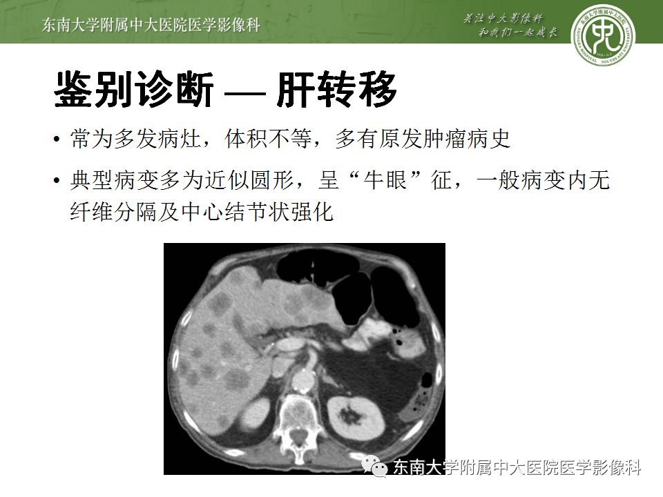 【病例】肝脏炎性肌纤维母细胞瘤1例CT影像表现