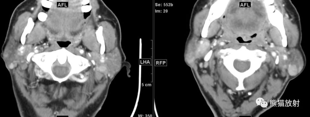 【病例】颌下腺炎症+腮腺腺淋巴瘤1例CT