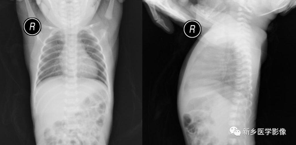早产婴肺 the Immature Lung