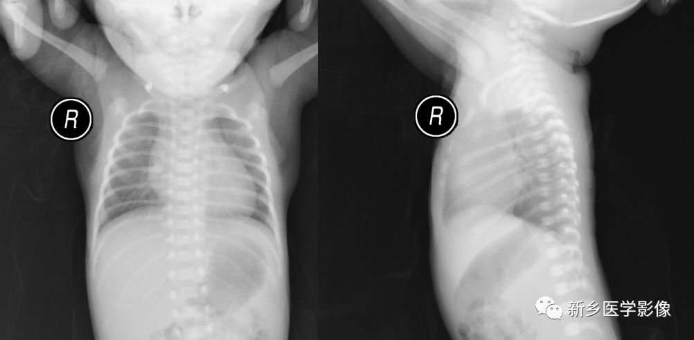 早产婴肺 the Immature Lung 早产婴肺 the Immature Lung