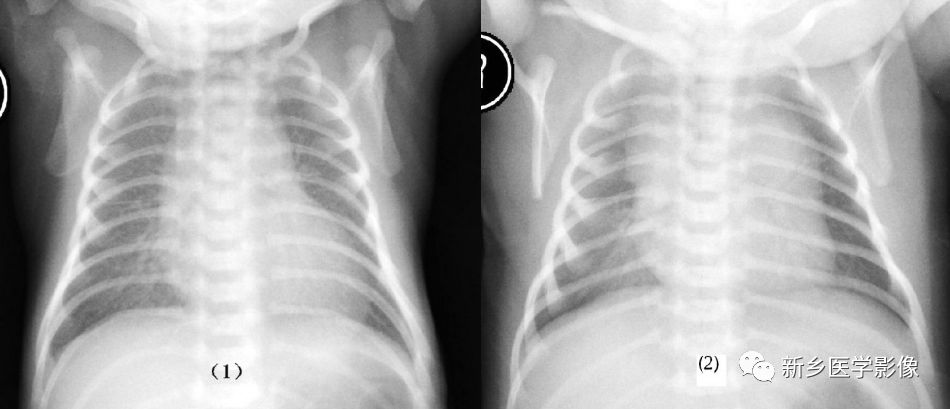 早产婴肺 the Immature Lung 早产婴肺 the Immature Lung