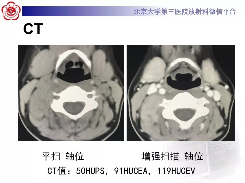 【病例】腹外型韧带样纤维瘤病1例CT及MR