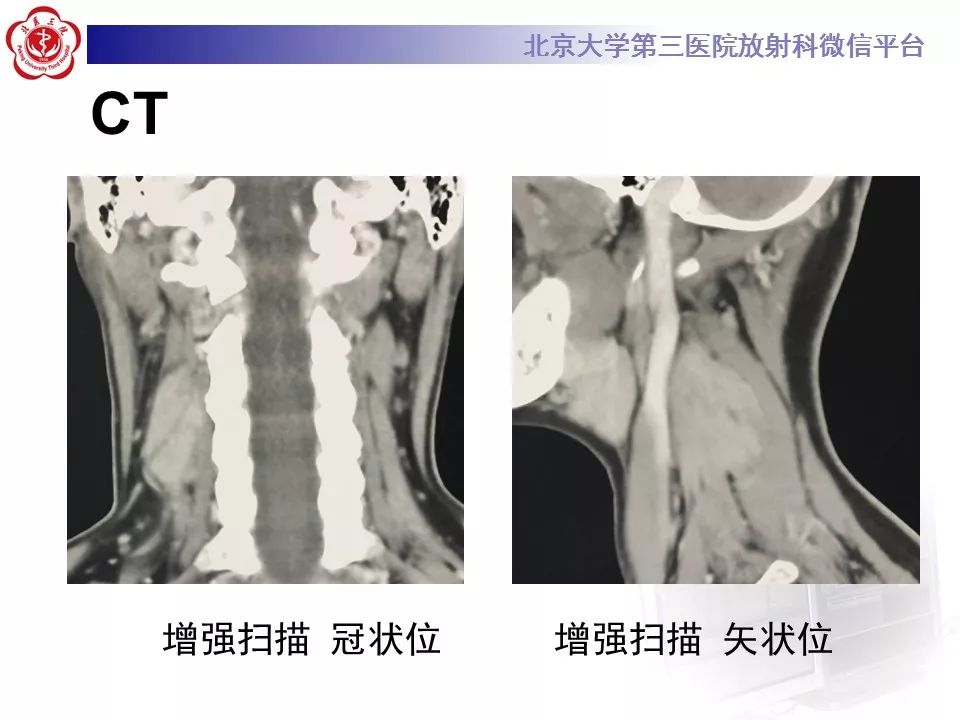 【病例】腹外型韧带样纤维瘤病1例CT及MR