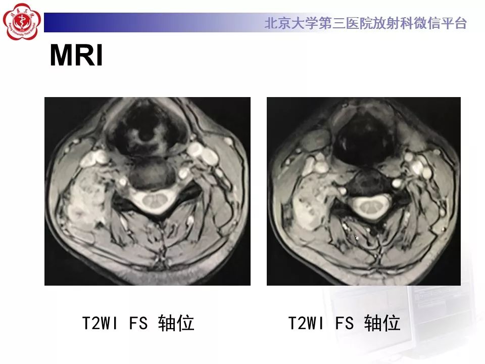 【病例】腹外型韧带样纤维瘤病1例CT及MR