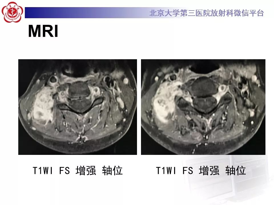 【病例】腹外型韧带样纤维瘤病1例CT及MR