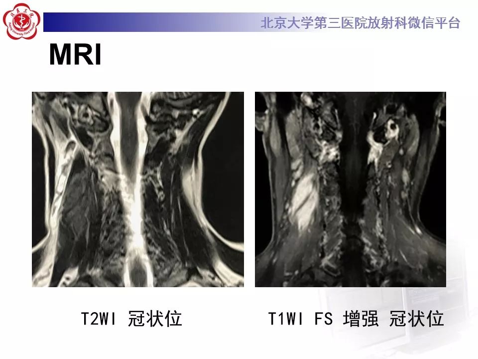 【病例】腹外型韧带样纤维瘤病1例CT及MR