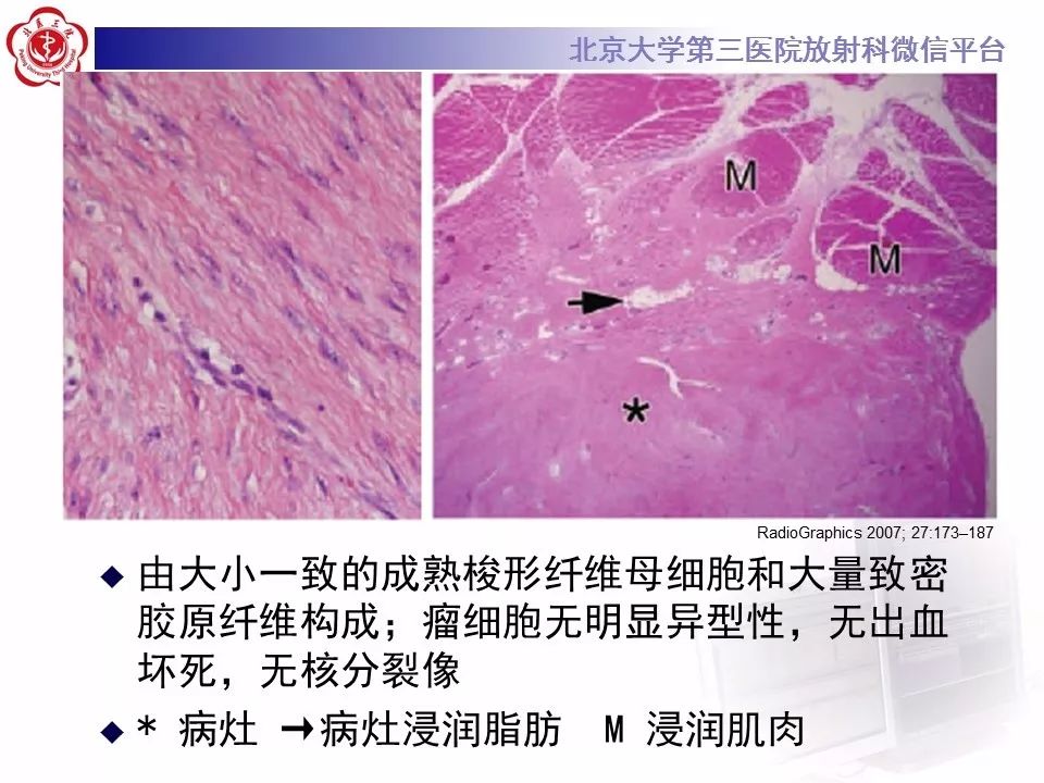 【病例】腹外型韧带样纤维瘤病1例CT及MR