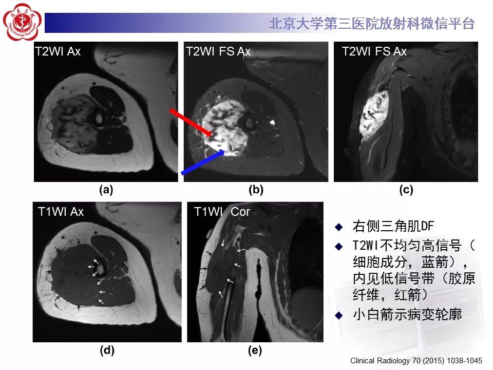 【病例】腹外型韧带样纤维瘤病1例CT及MR