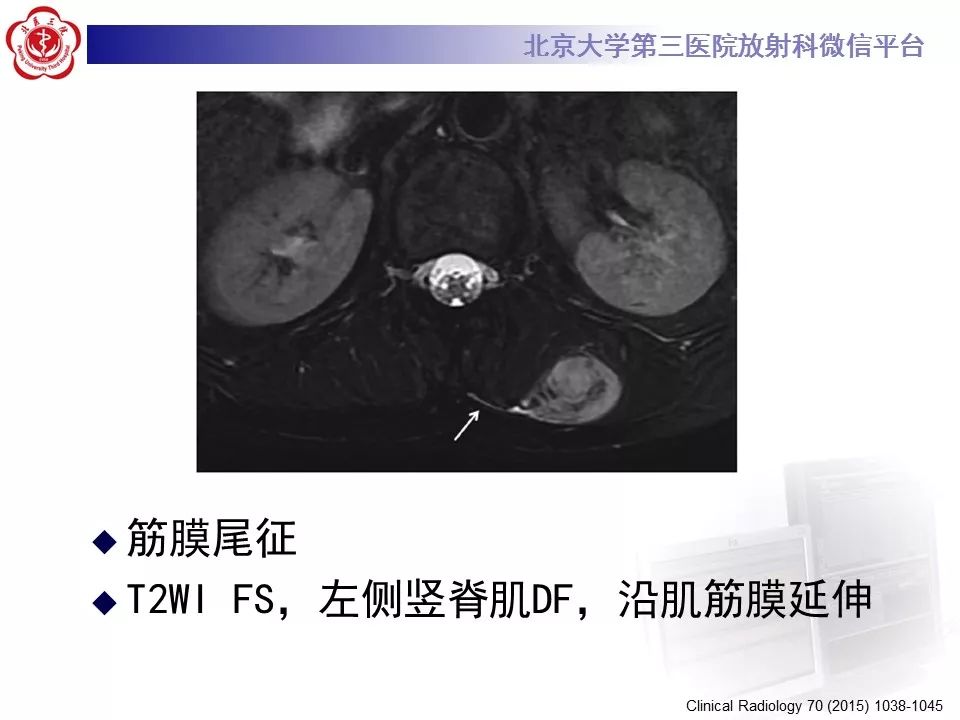 【病例】腹外型韧带样纤维瘤病1例CT及MR