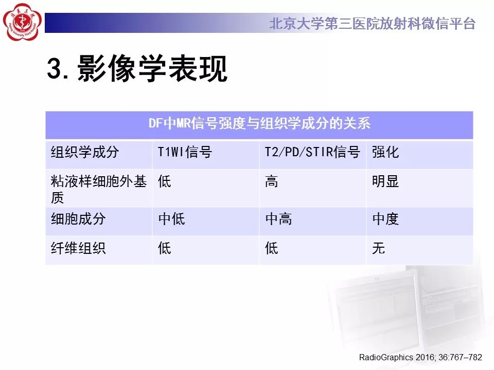 【病例】腹外型韧带样纤维瘤病1例CT及MR