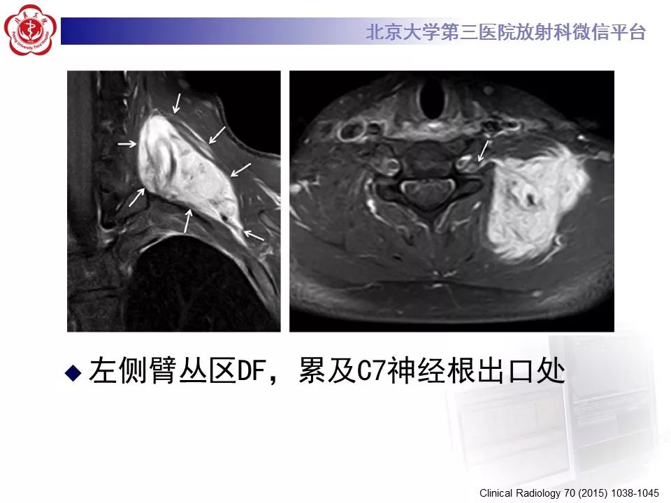 【病例】腹外型韧带样纤维瘤病1例CT及MR