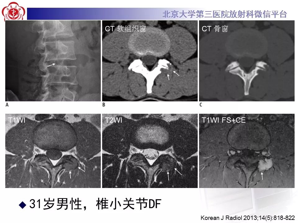 【病例】腹外型韧带样纤维瘤病1例CT及MR