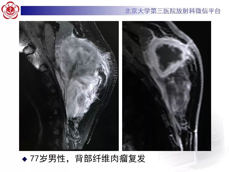 【病例】腹外型韧带样纤维瘤病1例CT及MR