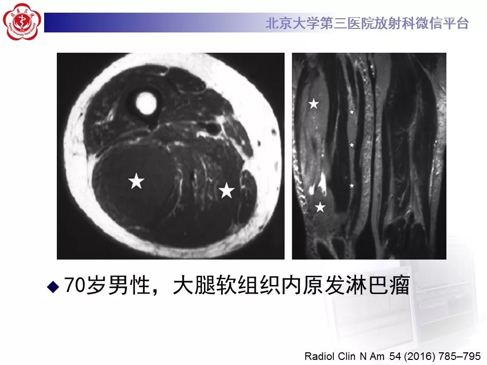 【病例】腹外型韧带样纤维瘤病1例CT及MR