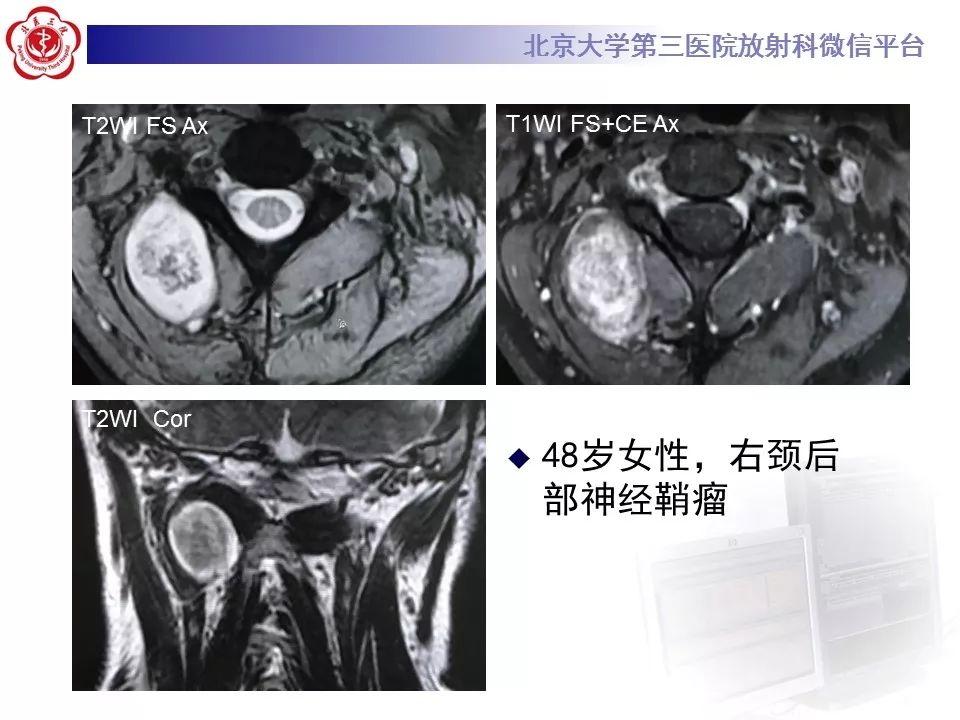 【病例】腹外型韧带样纤维瘤病1例CT及MR