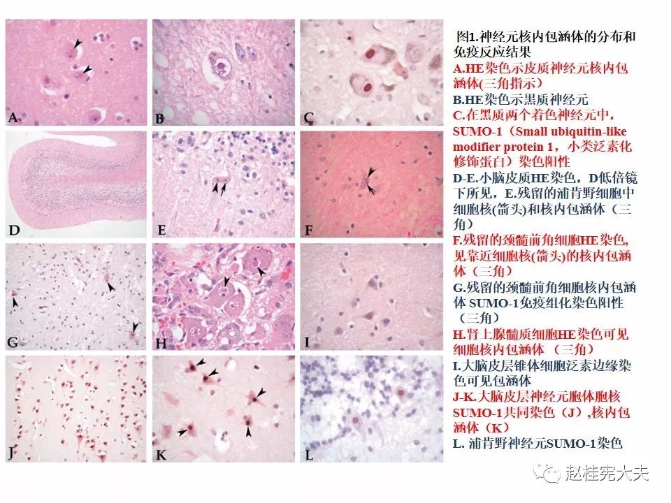 【PPT】神经元核内包涵体病（NIID）