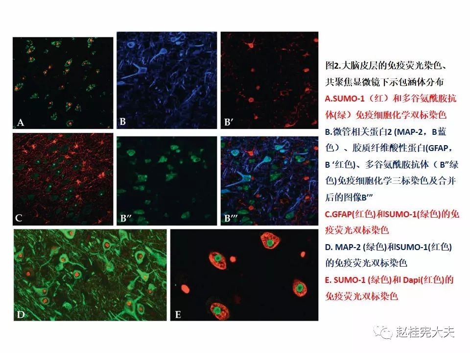 【PPT】神经元核内包涵体病（NIID）