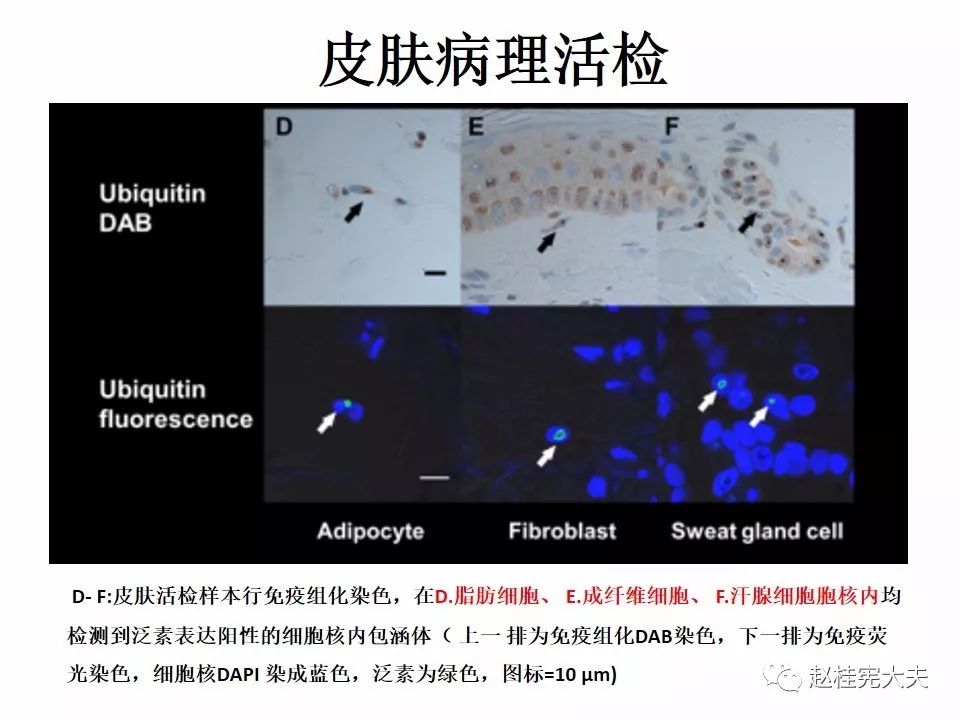 【PPT】神经元核内包涵体病（NIID）