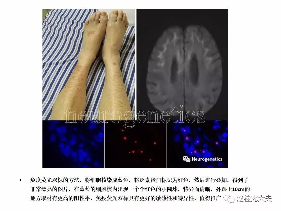 【PPT】神经元核内包涵体病（NIID）