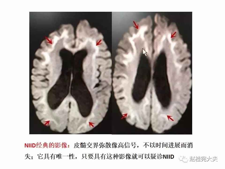 【PPT】神经元核内包涵体病（NIID）
