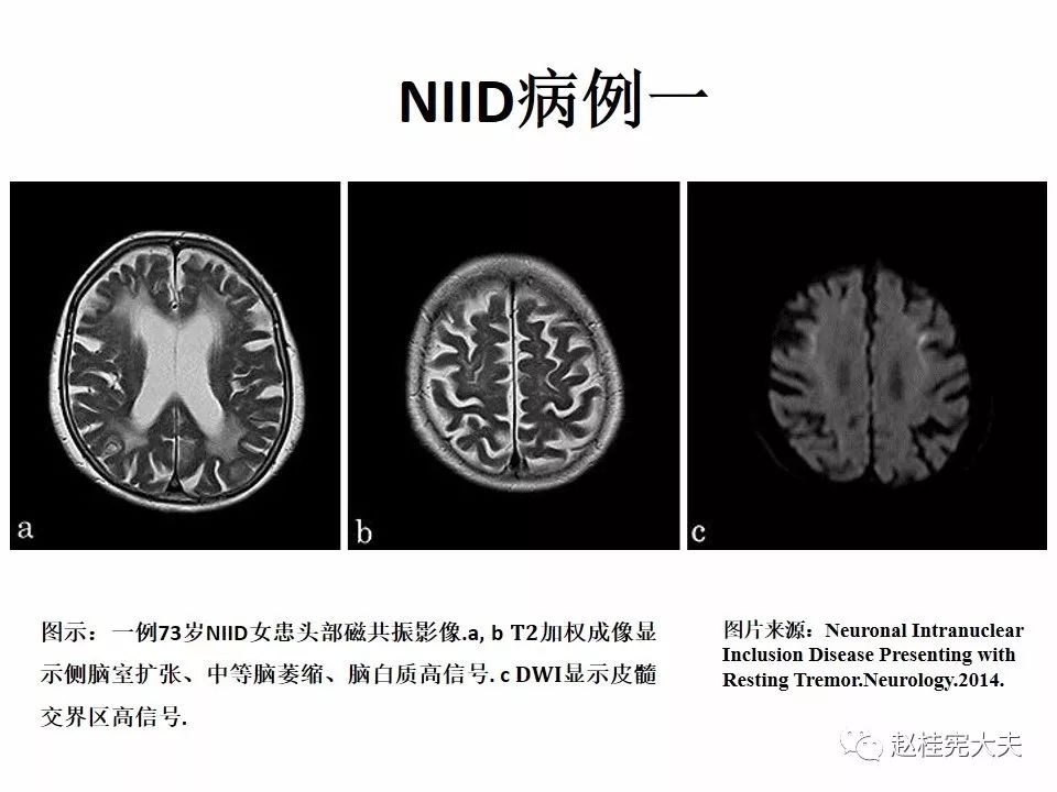 【PPT】神经元核内包涵体病（NIID）