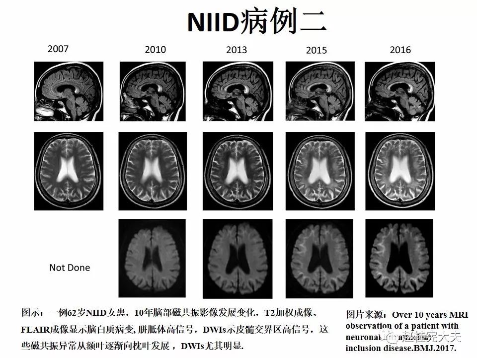 【PPT】神经元核内包涵体病（NIID）