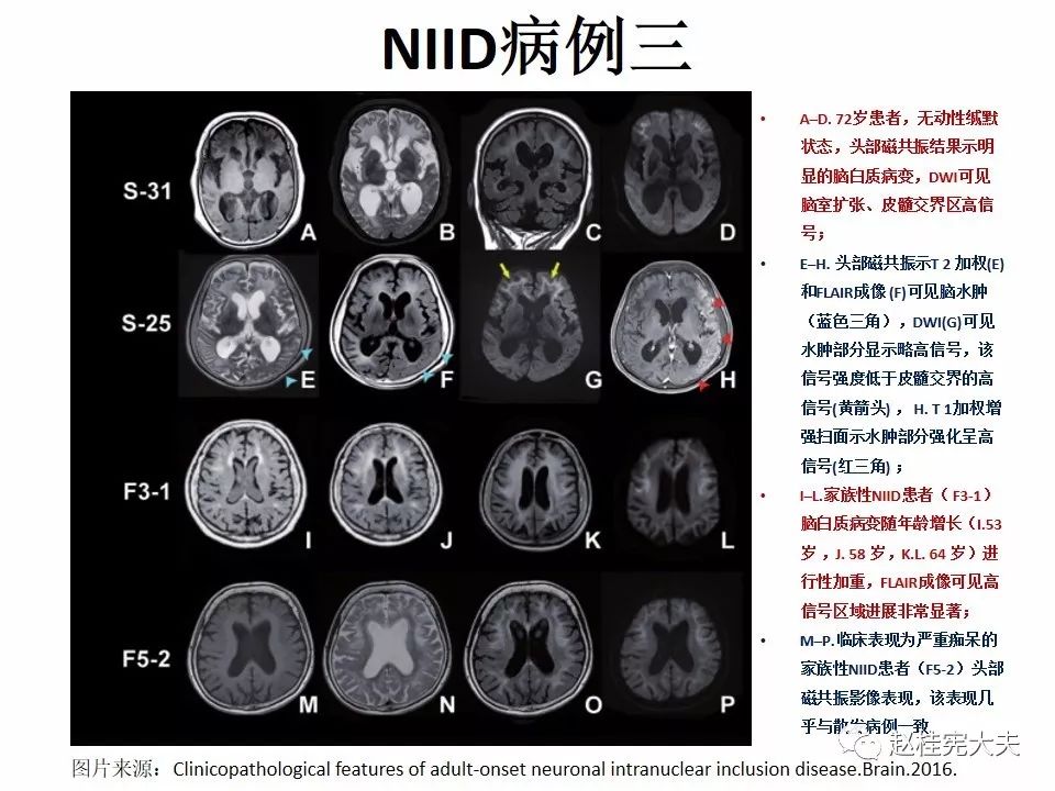 【PPT】神经元核内包涵体病（NIID）
