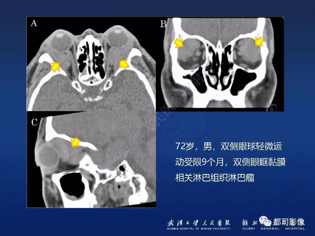 【PPT】眼眶黏膜相关淋巴组织淋巴瘤影像诊断