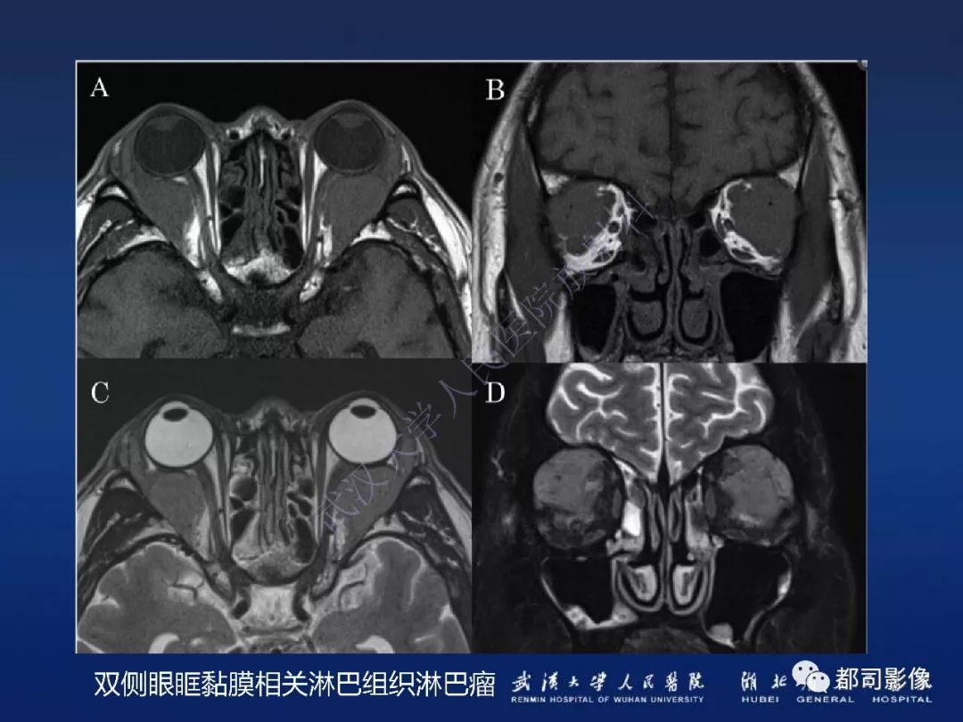 【PPT】眼眶黏膜相关淋巴组织淋巴瘤影像诊断