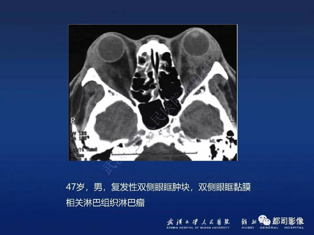 【PPT】眼眶黏膜相关淋巴组织淋巴瘤影像诊断