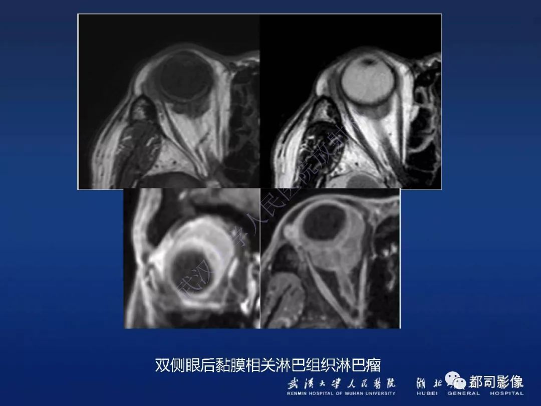 【PPT】眼眶黏膜相关淋巴组织淋巴瘤影像诊断