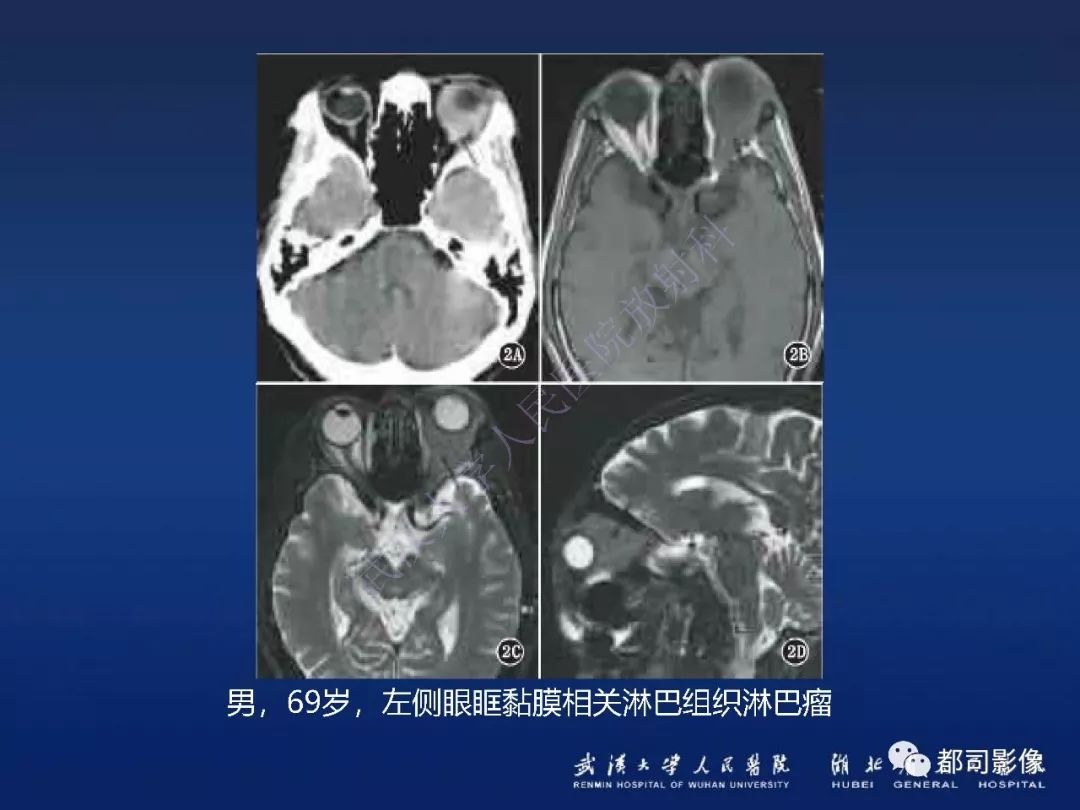 【PPT】眼眶黏膜相关淋巴组织淋巴瘤影像诊断