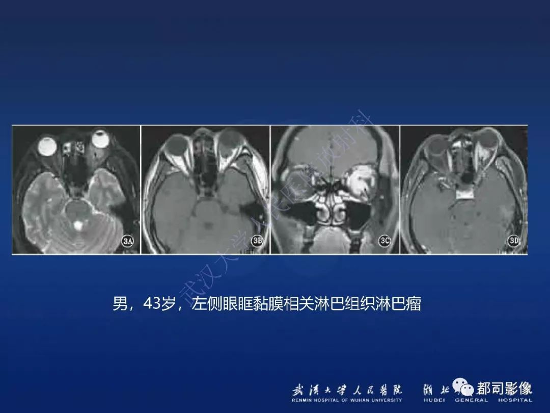 【PPT】眼眶黏膜相关淋巴组织淋巴瘤影像诊断