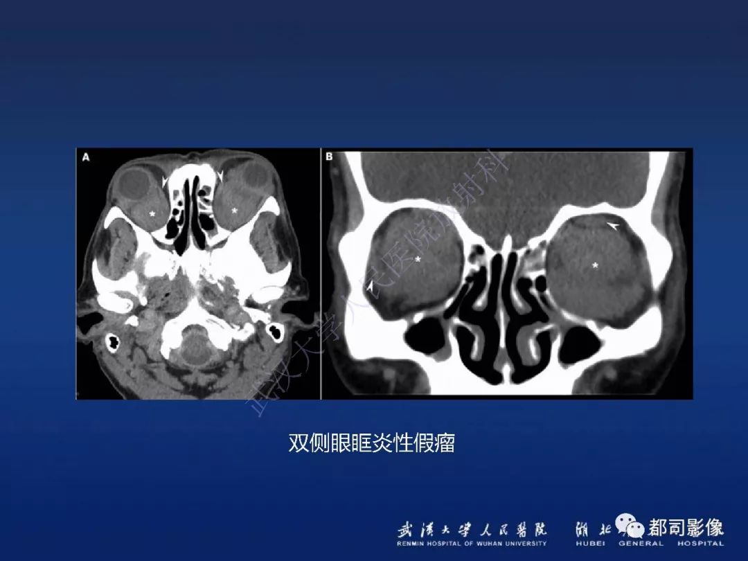 【PPT】眼眶黏膜相关淋巴组织淋巴瘤影像诊断