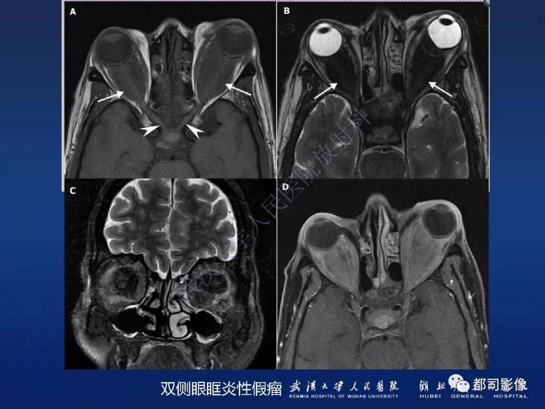 【PPT】眼眶黏膜相关淋巴组织淋巴瘤影像诊断